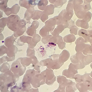 Image from the thin blood film (Giemsa stain, 100x). It shows a mobile form with peripheral flagella and a dark nucleus compatible with exflagellating microgametocyte.