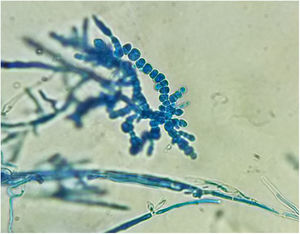 Chlamydoconidia chains characteristic of T. verrucosum in the microscopic examination with lactophenol blue (×40).