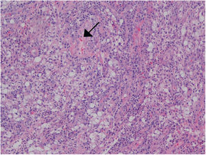 Haematoxylin and eosin: dense chronic inflammatory infiltrate with the presence of large foamy macrophages.