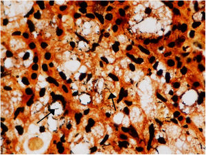 Warthin–Starry: presence of abundant bacilli in foamy macrophages (Mikulicz cells).