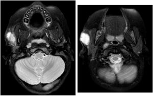 T1 and T2-weighted sequences with gadolinium: septated cystic mass in the right parotid gland compatible with an abscess.