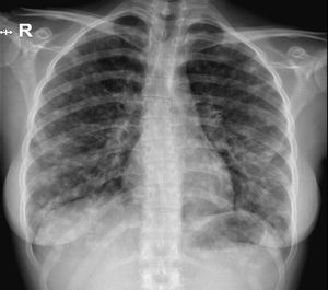 Chest X-ray upon admission of case 1.
