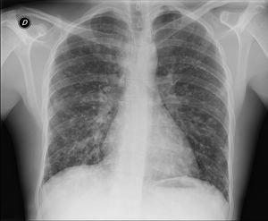 Chest X-ray upon admission of case 2.