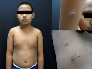 Nodular lesions in pectoral region. A nodular, crusty lesion can be observed on the arm.