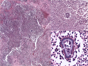 Histopathology: suppurative granuloma, with the presence of basophilic kidney-shaped granules and spikes in periphery (H&E, 10, 20 and ×40).