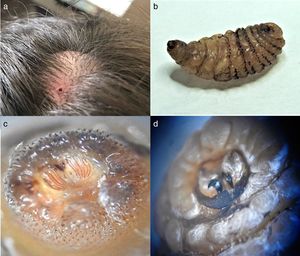 Skin lesion in the scalp and parasite. (a) Lump with a hole. (b) Dermatobia hominis larva. (c) D. hominis posterior spiracle. (d) D. hominis hooks.