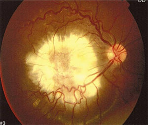 Ocular toxocariasis: a white mass in the posterior pole of the right eye extending towards the macula.