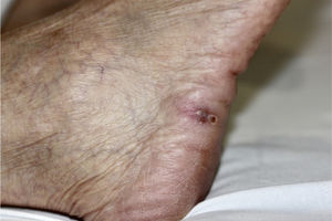 Purple nodule on an erythematous base on the lateral side of the right foot.