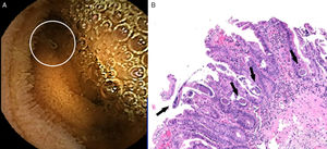 (A) Jejunum and duodenum segmentary changes: villous atrophy and edema, mucosal stripping, ulcers and stenosis. Visualization of the parasite Strongyloides stercoralis. (B) Various eggs and larvae morphologically compatible with Strongyloides stercoralis (H&E, 400×).