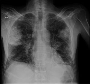 Bilateral alveolar infiltrate on chest radiography upon admission.