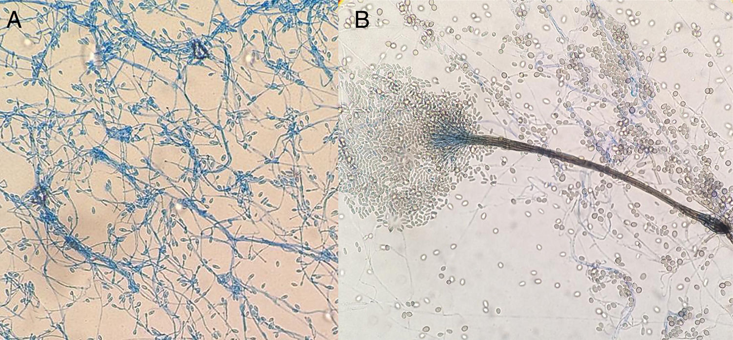 Complicated abscess by uncommon etiology | Enfermedades Infecciosas y ...
