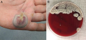 (A) Abscess of the palm of the hand with cellulitis and lymphangitis. (B) Cottony, woolly colonies, of central brown colouration and lighter and irregular margin in CNA 48h after incubation. The colour in the image can only be seen in the electronic version of the article.