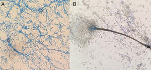 (A) Lateral conidiogenous cells or smooth-walled subhyaline terminals with production of subhyaline smooth-walled conidia measuring 5–14μm×3–5μm. (B) Graphium like: elongated and compact structure formed by stems of dark olive colour and subhyaline, cylindrical or claviform conidia with truncated base measuring 5–13μm×2–4μm. The colour in the image can only be seen in the electronic version of the article.