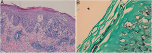 A: Epidermis with irregular acanthosis, spongiosis, polymorphonuclear exocytosis and parakeratosis; and a diffuse inflammatory infiltrate occupy the entire thickness of the dermis, composed of lymphocytes, polymorphonuclear cells, histiocytes, eosinophils and plasma cells (haematoxylin-eosin staining). B: Conidia and mycelia in the corneal layer (Grocott's staining).