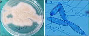 A: Powdery, flat and light brownish yellow coloured colonies, which matured after 7days in Sabouraud agar medium with chloramphenicol and gentamicin at 30̊C. B: Pyriform microconidia and spindle-shaped macroconidia, with rounded, equinulated ends, a thin wall and four to six septa were observed, compatible with Microsporum gypseum (microscopic examination with lactophenol blue).