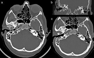 Computed tomography (CT) of ears and mastoids with axial (a) and coronal images (b) performed at the time of diagnosis of skull base osteomyelitis associated with right malignant otitis externa (MOE), which shows areas of osteolysis affecting the anterior and posterior walls and the floor of the external auditory canal, with sequestrations and small gas bubbles inside the compact bone and increased soft tissue inflammation (white arrows); (c) follow-up CT performed five months after surgical debridement and after a 3-month cycle of antifungal treatment confirming the resolution of MOE and of the osteomyelitis component.