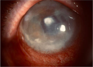 Central leukoma after abscess and stromal and endothelial oedema due to bullous keratopathy.