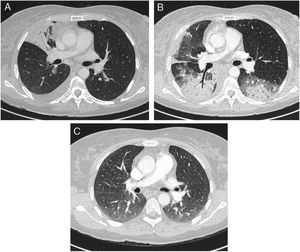 Chest CT of patient 1: (A) day 0: consolidation in lower right lobe; (B) day 12: ground glass opacities plus consolidations in bilateral upper lobes; (C) day 110: almost complete resolution of consolidations.
