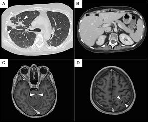 Radiologic findings. (A) Chest CT scan. Bilateral ground-glass opacifications, with nodules and consolidations in the right lung (white arrowheads). (B) Abdomen CT scan. Liver with well-defined, hypodense round lesions suggestive of abscesses (black arrowheads). (C) Brain MRI, T1 weighted sequence. Multiple brain abscesses, a small pontine lesion (white arrowheads), and (D) an intra-axial lesion in the left hemisphere, with a well-defined ring-enhancing wall and surrounding edema, that measure 18mm in diameter (white arrowheads).