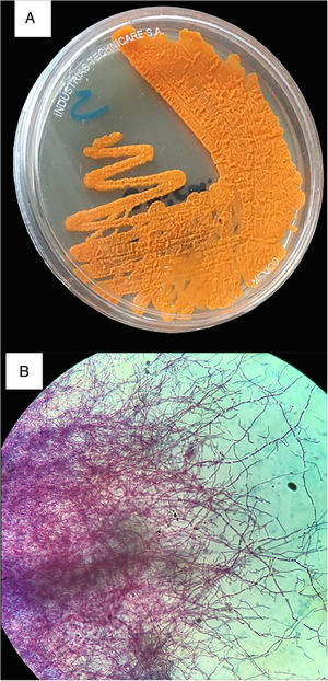 Culture and Kinyoun stain of Nocardia farcinica. (A) Sabouraud Dextrose Agar. The colonial morphology is variable, here displayed pigment-producing orange colonies. (B) Kinyoun Stain, X100. Branching filamentous rods that are partially acid fast.