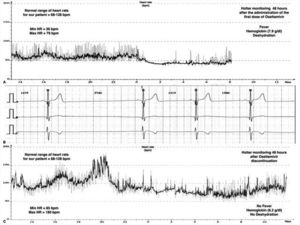 Cardiac rhythm monitoring of our patient. Panel A is the record of the HR variability during the first Holter performed the third day of treatment with Oseltamivir, showing a severe bradycardia for age. Panel B is a capture of the cardiac monitor of the patient the first day of treatment with Oseltamivir, showing a sinus bradycardia (30–50bpm). Panel C is the record of the HR variability during the Holter performed after 48h of the discontinuation of Oseltamivir, showing a complete recovery of normal HR for age.