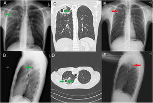 (A) Chest X-ray PA film showing right upper lobe cavitary lesion (green arrow). (B) Chest X-ray lateral film showing right upper lobe cavitary lesion (green arrow). (C) CT chest coronal view showing right upper lobe cavitary lesion (green arrow). (D) CT chest axial view showing right upper lobe cavitary lesion (green arrow). (E) Chest X-ray PA film showing right upper lobe scarring in area of previous cavitary lesion (red arrow). (F) Chest X-ray lateral film showing right upper lobe scarring in area of previous cavitary lesion (red arrow).