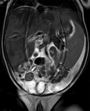 MRI image of the patient in which moderate–severe hepatomegaly and splenomegaly can be seen.