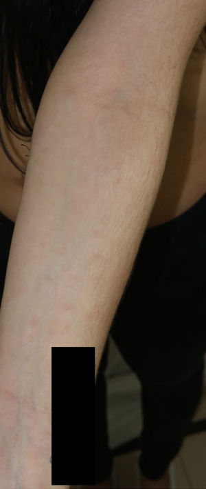 Hyperchromic macular rash on the forearm of the patient's mother.