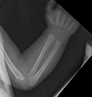 X-ray with radiolucent bands in distal radial metaphysis.
