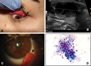 (A) Image showing papillary follicular conjunctivitis next to a granuloma with an ulcerated surface in the upper tarsal conjunctiva of the left eye. (B) Ultrasound of case 2 wherein a 2.79cm adenopathy is identified with small foci of necrosis. (C) Slit-lamp photograph showing a conjunctival granuloma protruding from the bottom of the lower conjunctival sac of the right eye. (D) Biopsy of a submandibular adenopathy wherein clustered epithelioid histiocytes suggestive of granulomatous lymphadenitis are identified.