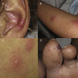 Clinical manifestations of cutaneous type 2 lepra reaction. (A) Subcutaneous, indurated and painful nodule in the auricular pavilion. (B) Nodule on the extensor face of the arm. (C) Erythematous oedematous plaques with central vesiculation, similar to erythema multiforme. (D) Violet-coloured erythematous papules that can evolve to necrosis and ulceration.