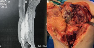 (A) CT scan showing collection attached to the femur with a hypervascular wall and without solid structures inside. (B) Image of the surgery showing the lesion produced after debridement.