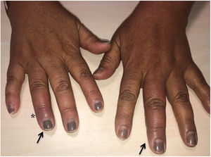 Purplish erythema on the 3rd finger of the left hand and distal portion of the 4th finger of the right hand (arrows), with mild associated oedema. On the side of the 4th finger of the right hand, the entry point (asterisk) can be seen.