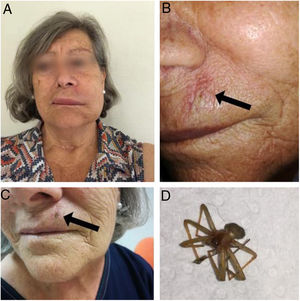 Clinical features and Loxosceles rufescens specimen. (A) Left facial asymmetric oedema 6h after spider bite. (B) Pale plaque (arrow) 24h after spider bite. (C) Necrotic eschar (arrow) 7 days after spider bite. (D) L. rufescens.