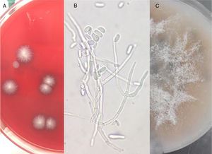 Macroscopic and microscopic findings. A. Blood agar: hairy, flat, white and round colonies. B. Preparation with KOH of the blood agar plate: hyaline septate hyphae with branching at an acute angle and macroconidia are observed. C. Oatmeal agar: greyish-white colonies with a smooth and cottony appearance.