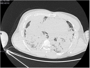 A CT scan of the chest in which bilateral pulmonary consolidations are observed.
