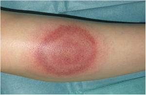 Erythematous patch in which a central ring and another peripheral ring with a violaceous or purplish hue can be seen.