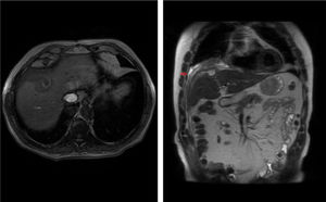Liver MRI: the image on the left shows a characteristically hyperintense lesion in a T1 sequence without intravenous contrast. The image on the right shows the abscess with the postdrainage fistula in a T2 sequence.