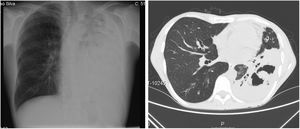 Chest radiograph showing diffuse and homogeneous opacities on the left lung and axial chest CT scan showing left pulmonary consolidation affecting mainly the lower lobe with cavitation areas of appreciable dimensions.