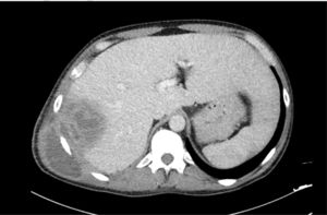 Abdominal CT image.