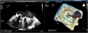 Transesophageal echocardiography, shows vegetation on the medial side of the prosthetic ring of about 8mm.
