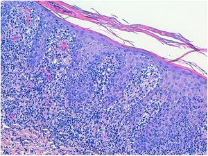 Haematoxylin–eosin staining, inflammatory infiltrate in the dermis, perivascular in location.