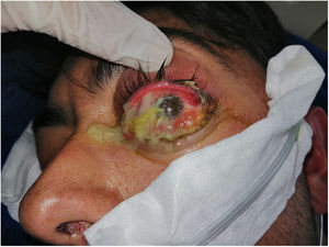 Palpebral oedema, eyelid erythema, proptosis, 360° chemosis, with abundant purulent discharge.