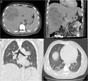 A) Liver increased in size (25cm) with normal contours and shape, with a multiloculated hypodense image with well-defined borders measuring 165×118×105mm. B) Lung nodules in the right upper, middle and lower lobes, some of them cavitary.