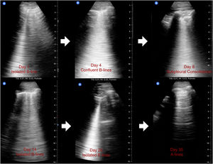 Changes in ultrasound findings from onset of symptoms to complete resolution on ultrasound in patient 2.