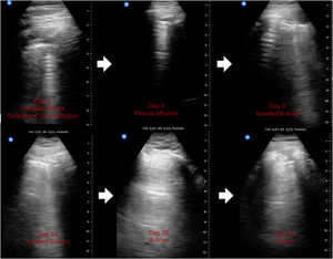 Changes in ultrasound findings from onset of symptoms to complete resolution on ultrasound in patient 3.