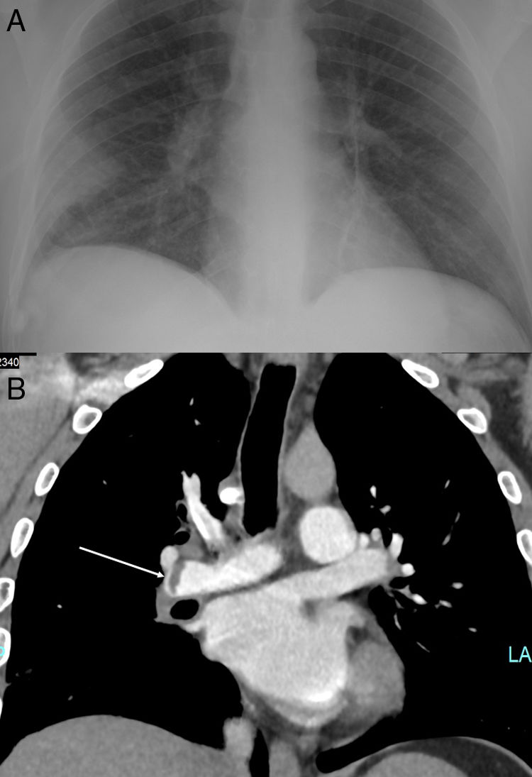 Dyspnea and pleuritic chest pain during the COVID19 pandemic