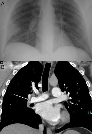 (A) Hampton's hump. (B) Computerized tomography angiography. Arrow shows the thromboembolism at the right pulmonary artery.