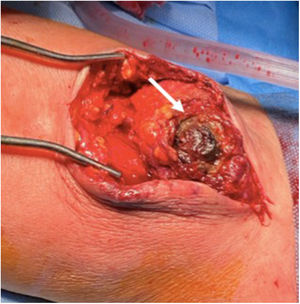 Intraoperative view. Disruption of the AVF venous wall is indicated with the white arrow.
