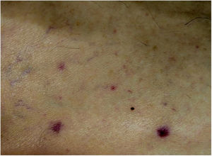 Detail of rash consisting of erythematous maculopapules measuring a millimetre on the thighs.